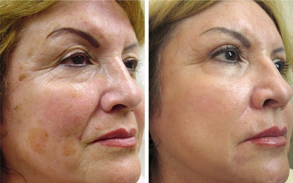 Laserové frakčné omladenie tváre, pokožky tela. Clear Brilliant, USA. Klady a zápory, recenzie