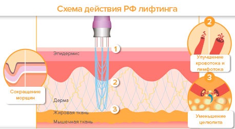Ansiktsløftning: hva er det, SMAS, RF, plasma, massasje, ultralyd, filament, endoskopisk, radiobølge, vektor, radiofrekvens, laser, akupunktur