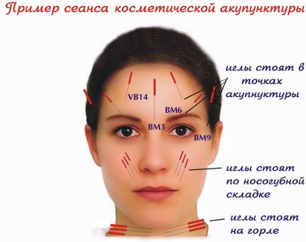 Mengangkat wajah: apa itu, SMAS, RF, plasma, urut, ultrasonik, filamen, endoskopi, gelombang radio, vektor, frekuensi radio, laser, akupunktur