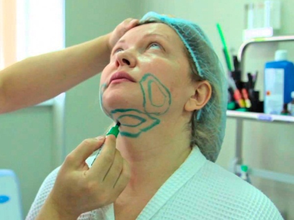 Lipolítics per a la cara, la barbeta, el nas. Resultats de l'aplicació, preus, efectes secundaris de les injeccions de mesoteràpia