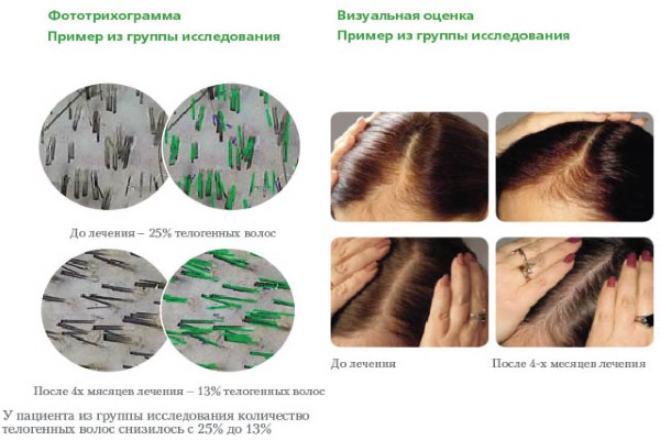 Pantovigar. Instructions d'utilisation, composition, comment prendre des vitamines contre la chute des cheveux, pour la croissance des cheveux. Analogues