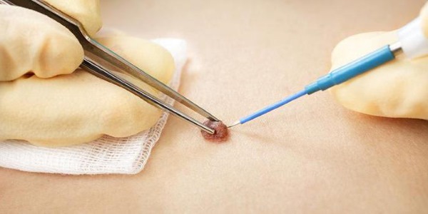 Làm thế nào để loại bỏ u nhú trên cơ thể bằng các biện pháp dân gian, thuốc, phương pháp phẫu thuật