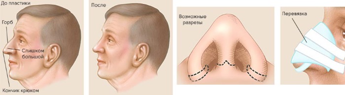 Cirurgia plàstica al nas. Tipus, preus: correcció de l’envà, reducció del nas, eliminació de la gepa, remodelació, rinoplàstia de contorn