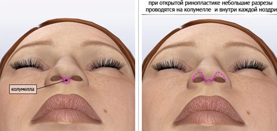 Cirurgia plàstica al nas. Tipus, preus: correcció de l’envà, reducció del nas, eliminació de la gepa, remodelació, rinoplàstia de contorn