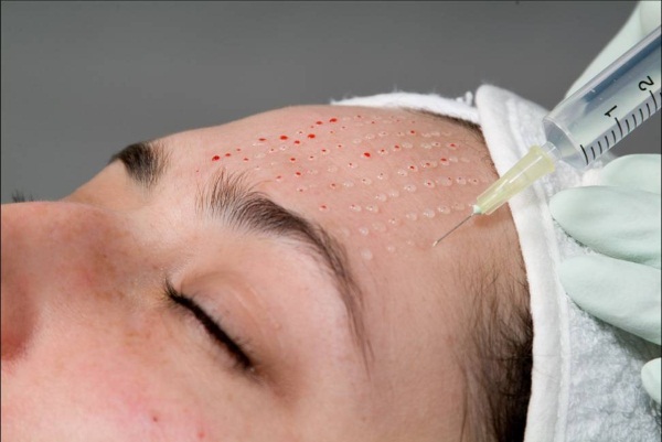 L'acné sur le menton chez les femmes sur le visage. Causes d'apparition après 30 ans, pendant la grossesse. Quel organe est en panne, remèdes maison