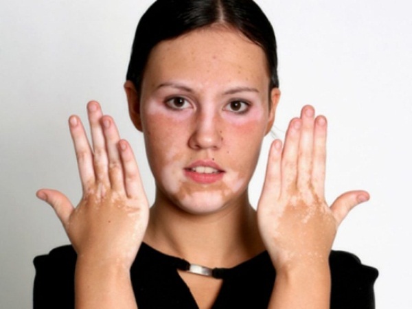Acne på hakan hos kvinnor i ansiktet. Orsaker till utseende efter 30 år, under graviditeten. Vilket organ som inte fungerar, hemmet