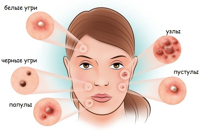 L'acné sur le menton chez les femmes sur le visage. Causes d'apparition après 30 ans, pendant la grossesse. Quel organe est en panne, remèdes maison