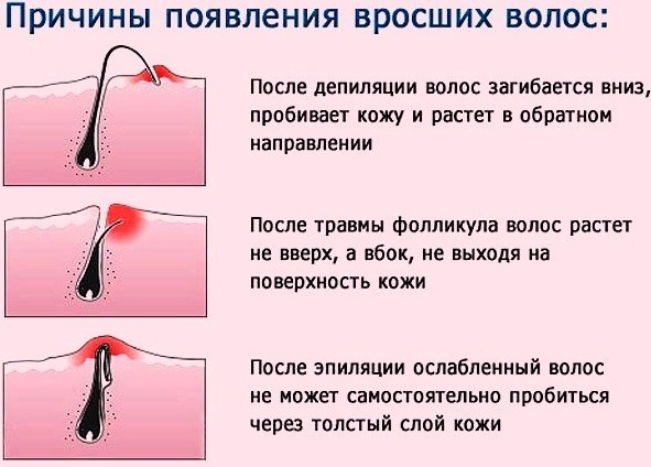 إزالة الشعر عند النساء في الأماكن الحميمة ، منطقة البكيني. كيف نفعل ، أي كريم ، منتج ، نزع الشعر هو الأفضل