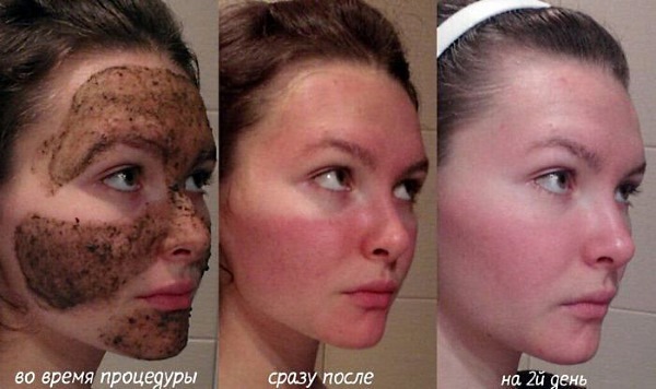 Bodyagu pour le visage contre les ecchymoses, l'acné, les taches de vieillesse. Instructions, recettes d'utilisation, résultats et photos