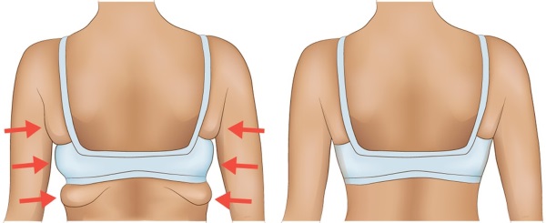 Come rimuovere le pieghe di grasso sulla schiena in breve tempo. Esercizio, dieta, massaggio