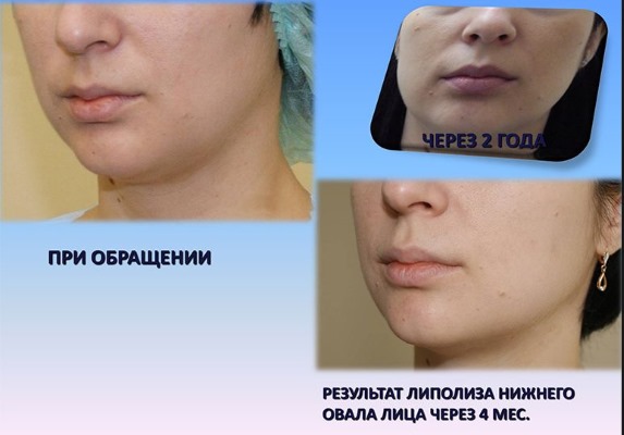 Laser liposuction.What is it, how is it done for the abdomen, chin, face, thighs, cheeks, legs, buttocks, arms, widow's hump. Before and after photos, reviews, price of the procedure