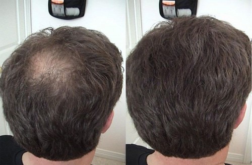 Liệu pháp plasma cho tóc và da đầu: nó là gì, kết quả, chỉ định và chống chỉ định