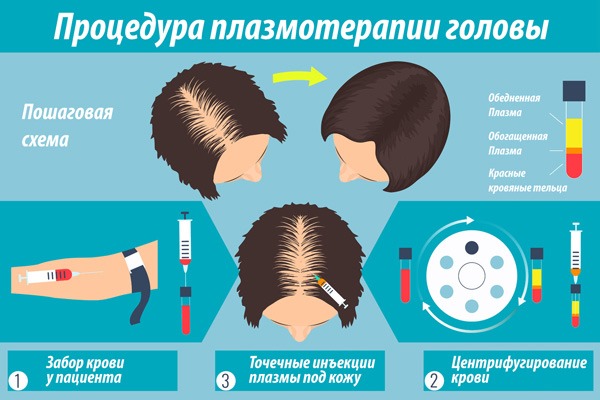 Терапија плазмом за косу и власиште: шта је то, резултати, индикације и контраиндикације