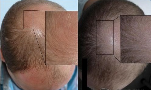 Plasma terapia per capelli e cuoio capelluto: cos'è, risultati, indicazioni e controindicazioni