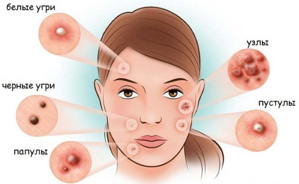Retinoïden lokaal, systemisch, actueel, extern voor het gezicht voor acne, rimpels, acne, psoriasis. Tabletten, crèmes, zalven, lotions