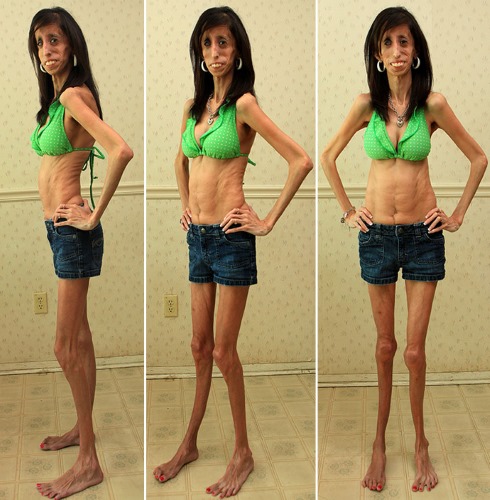 คนที่แย่ที่สุดในโลกคือผู้หญิง สาว Anorexic นางแบบคนดัง. รูปภาพ