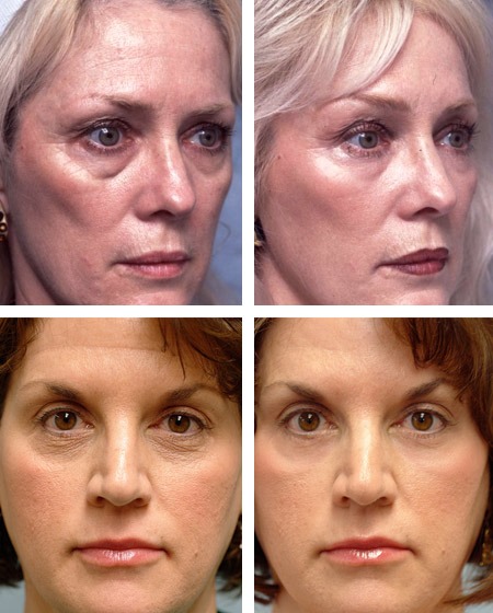 Solcoseryl en cosmétologie pour le visage des rides, des ecchymoses sous les yeux. Instructions d'utilisation, avis des cosmétologues
