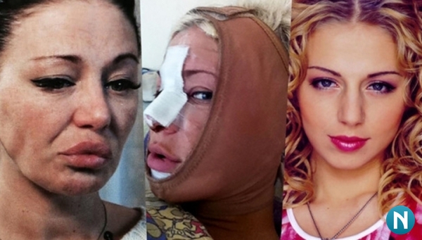 النجوم قبل وبعد الجراحة التجميلية. صور روسية وهوليودية وكورية فاشلة ضحايا انستغرام بالمنزل 2