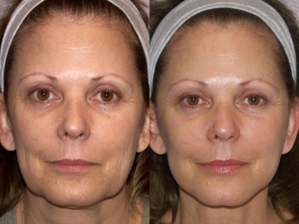 Perbaiki muka tanpa pembedahan dengan Margarita Levchenko. Pelajaran video latihan, faedah kaedahnya