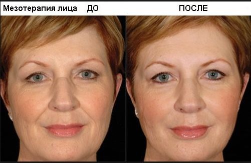 Asid hyaluronik dalam kosmetologi. Suntikan, tablet, krim muka. Faedah, sebelum dan selepas gambar. Ulasan ubat