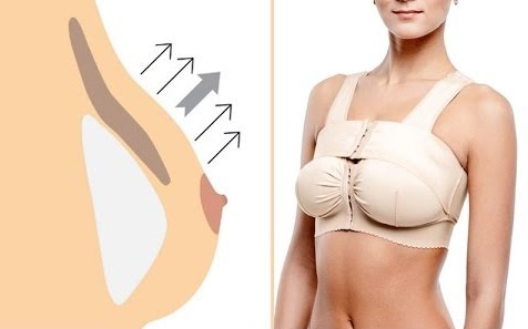 Pengangkatan payudara tanpa implan. Prosedur dan kaedah untuk menganjalkan payudara dalam kosmetologi