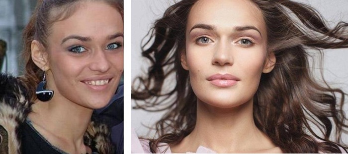 Alena Vodonaeva avant et après les plastiques. Photo, paramètres de forme, taille, poids, couleur des cheveux. Chirurgie de réduction du nez qui a fait aux dents