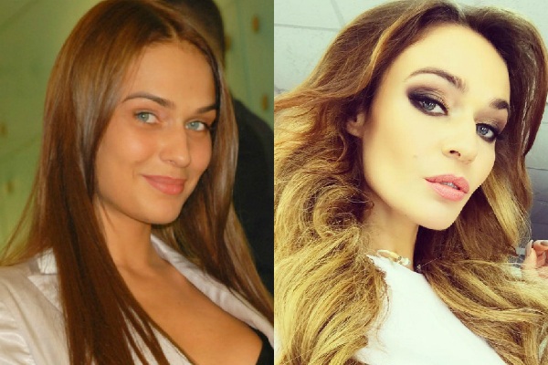 Alena Vodonaeva sebelum dan selepas plastik. Foto, parameter bentuk, tinggi, berat, warna rambut. Pembedahan pengurangan hidung yang dilakukan pada gigi