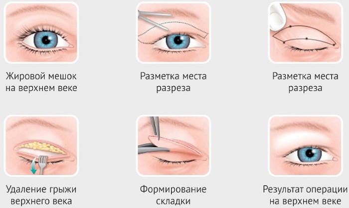 Blepharoplasty di Moscow. Harga pada tahun 2020, penilaian klinik, cara memilih pakar bedah, promosi, potongan harga