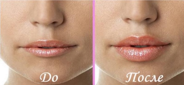 Restylane filler, biorevitalization. Reviews. Vital, Perline, Skinbooster for lip augmentation, under the eyes. Price, efficiency, photo