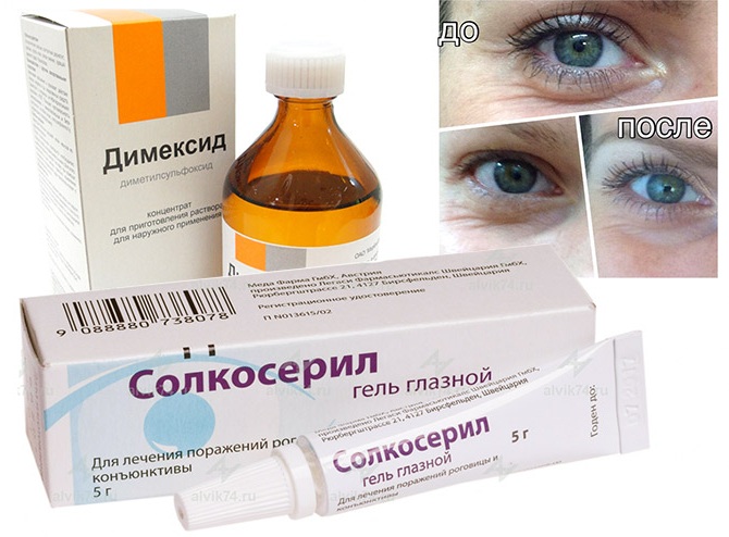 Solcoseryl. Instructions for the use of an ointment for the face against wrinkles, acne, a mask with Dimexidum. Price