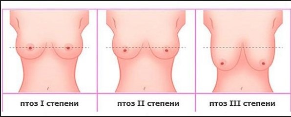 Aumento de senos. Costo en Moscú, San Petersburgo. Tipos de implantes, precios