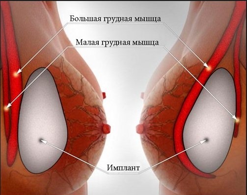 Brustvergrößerung. Kosten in Moskau, St. Petersburg. Arten von Implantaten, Preise