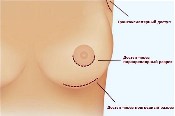 Powiększenie piersi. Koszt w Moskwie, Sankt Petersburgu. Rodzaje implantów, ceny
