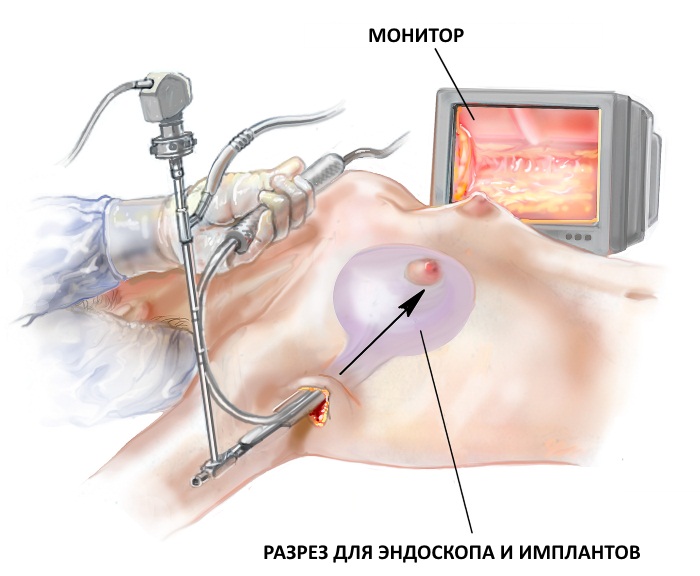 Augmentation mammaire. Coût à Moscou, Saint-Pétersbourg. Types d'implants, prix