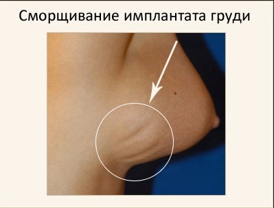 Προσθετική στήθους. Κόστος στη Μόσχα, Αγία Πετρούπολη. Τύποι εμφυτευμάτων, τιμές