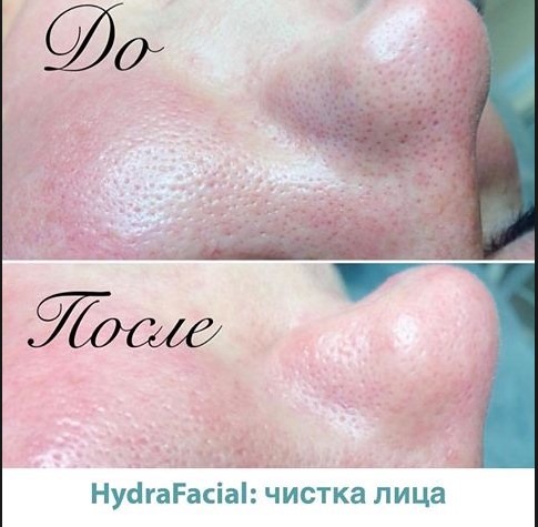 Vacuum hydropeeling Hydra Feshl hydrafacial. What is this procedure, description, devices, price