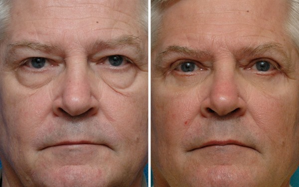 Blepharoplasty. Reviews of the operated. Pros and cons of plastic surgery, complications, rehabilitation. Laser, transconjunctival, circular, injection