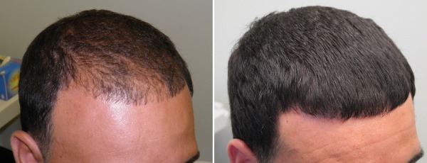 Mesoterapia del cuero cabelludo del cuero cabelludo. Qué es, efecto, precio. Como hacerlo en casa