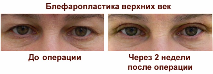 Laser ooglidcorrectie. Recensies van de geopereerde onderste, bovenste oogleden, hoe ze het doen. Prijzen
