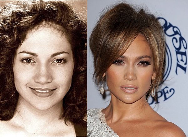 Jennifer Lopez. Foto de maiô, figura os parâmetros antes e depois da cirurgia plástica