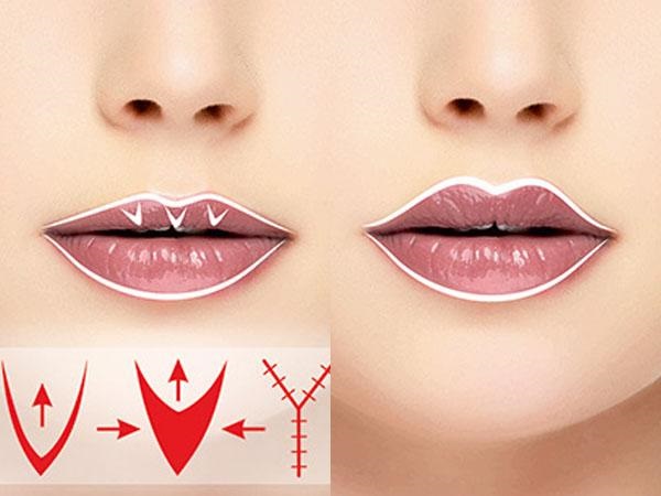 วิธีการขยายริมฝีปากด้วยกรดไฮยาลูโรนิกโบทอกซ์ซิลิโคนการเติมไขมันการทำคีโลพลาสต์ ภาพถ่ายราคาบทวิจารณ์