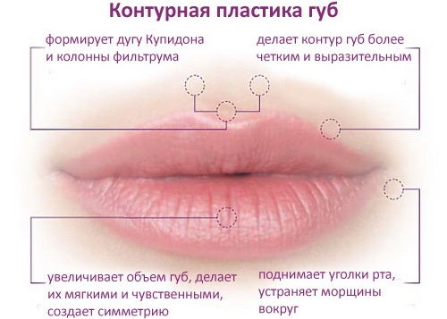 Cara membesarkan bibir dengan asid hyaluronik, botox, silikon, lipofilling, cheiloplasty. Foto, harga, ulasan