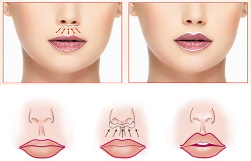 Comment agrandir les lèvres avec de l'acide hyaluronique, du botox, du silicone, du lipofilling, de la cheiloplastie. Photos, prix, avis