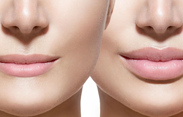 Cara membesarkan bibir dengan asid hyaluronik, botox, silikon, lipofilling, cheiloplasty. Foto, harga, ulasan