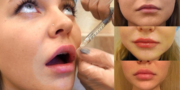 Wie man die Lippen mit Hyaluronsäure, Botox, Silikon, Lipofilling, Cheiloplastik vergrößert. Fotos, Preise, Bewertungen