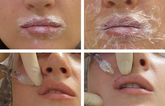 Comment agrandir les lèvres avec de l'acide hyaluronique, du botox, du silicone, du lipofilling, de la cheiloplastie. Photos, prix, avis