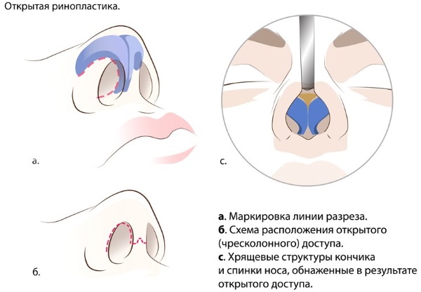 Rinoseptoplastia. Qué es, abierto, cerrado, cirugía láser, período de rehabilitación, precios