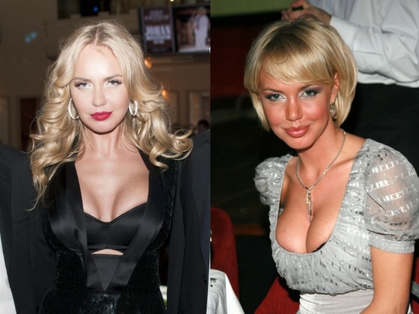 Pelakon Rusia dengan payudara besar sebelum dan selepas pembedahan plastik. Gambar