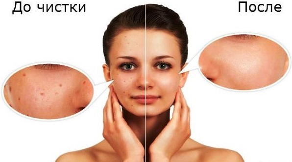 إزالة البقع العمرية على الوجه بالليزر ، وميض الصور ، والنيتروجين السائل ، والعلاجات الشعبية