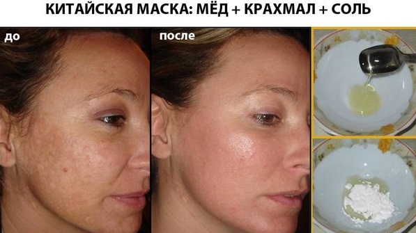 Menghilangkan bintik-bintik usia di wajah dengan laser, flash foto, nitrogen cair, ubat-ubatan rakyat
